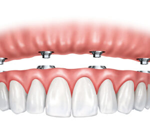 PDM_Ball-Retained-Dentures