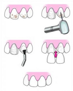 dental-veneer-placement-procedure