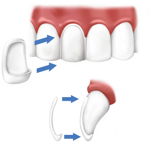 dental-veneers